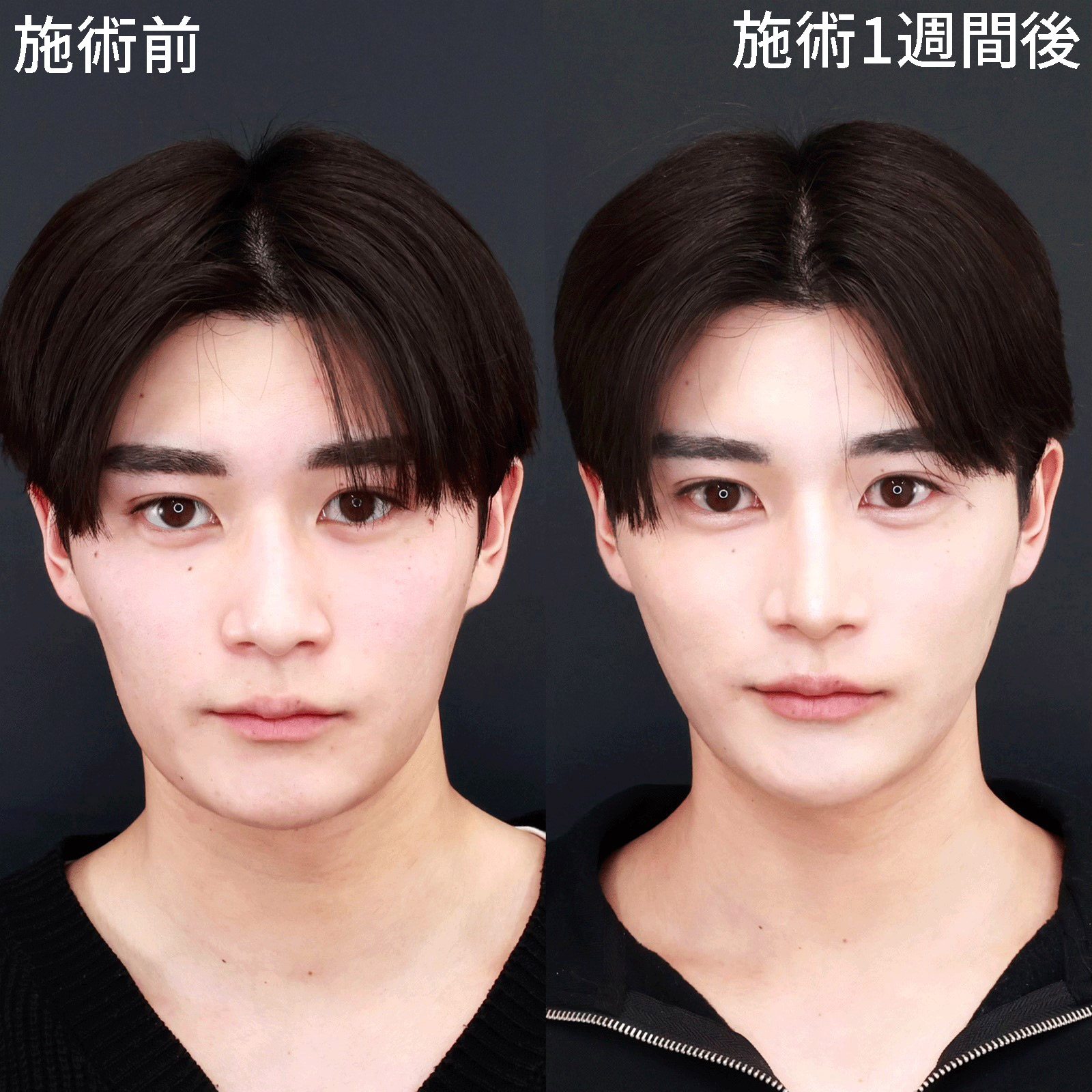 【糸リフト極】ビジュに磨きがかかる！メンズの垢抜けも小顔整形がおすすめ