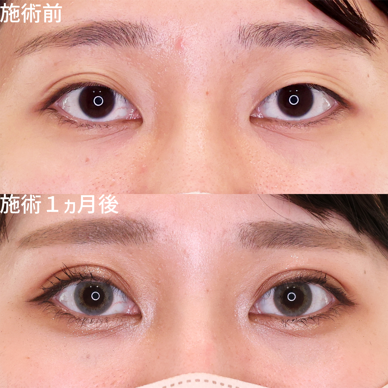 プチ整形で可愛い二重に 左右非対称な多重線まぶたを改善【埋没法】