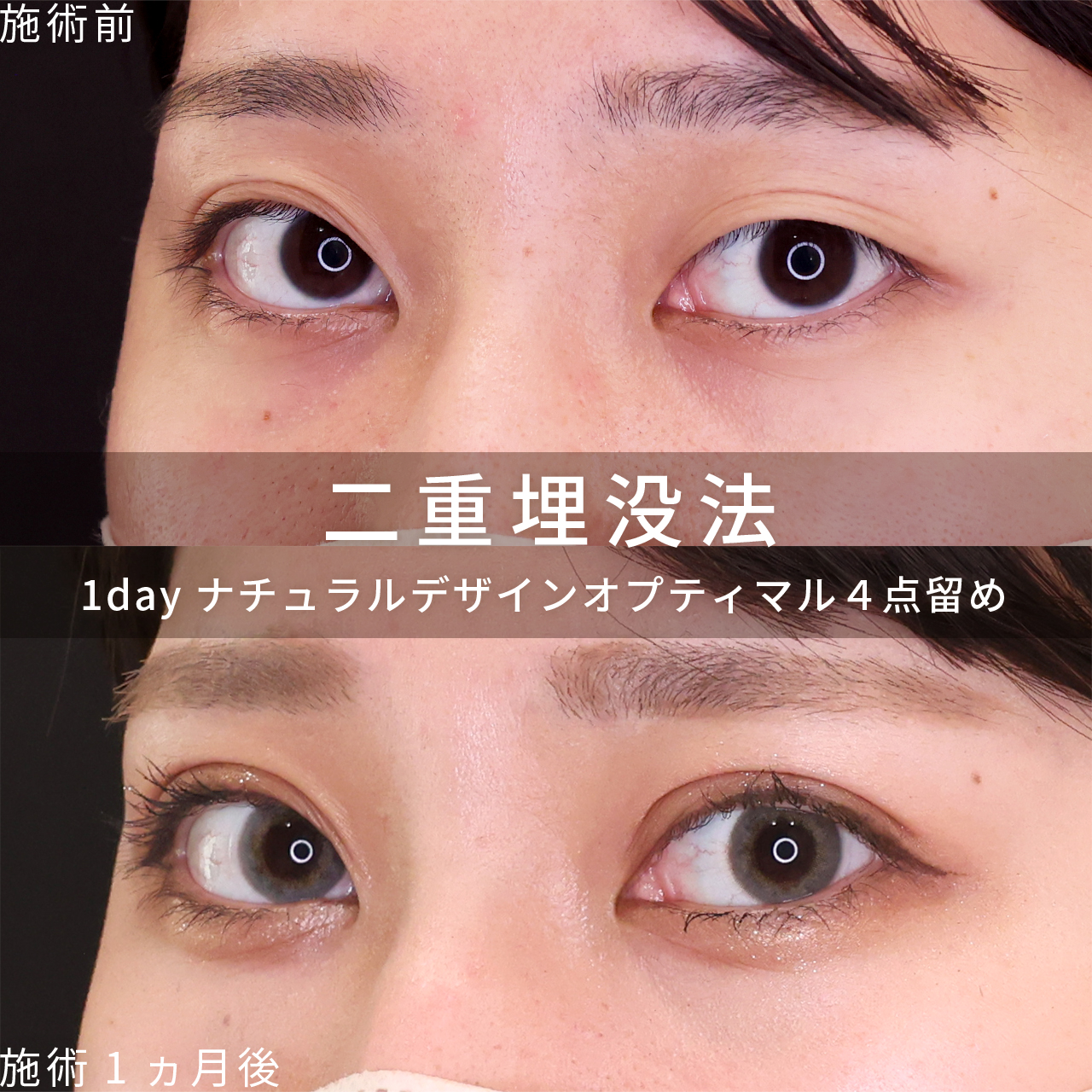 二重埋没法の症例写真 施術前後