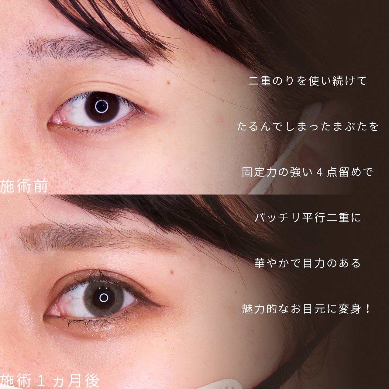 二重埋没法の症例写真 施術前後