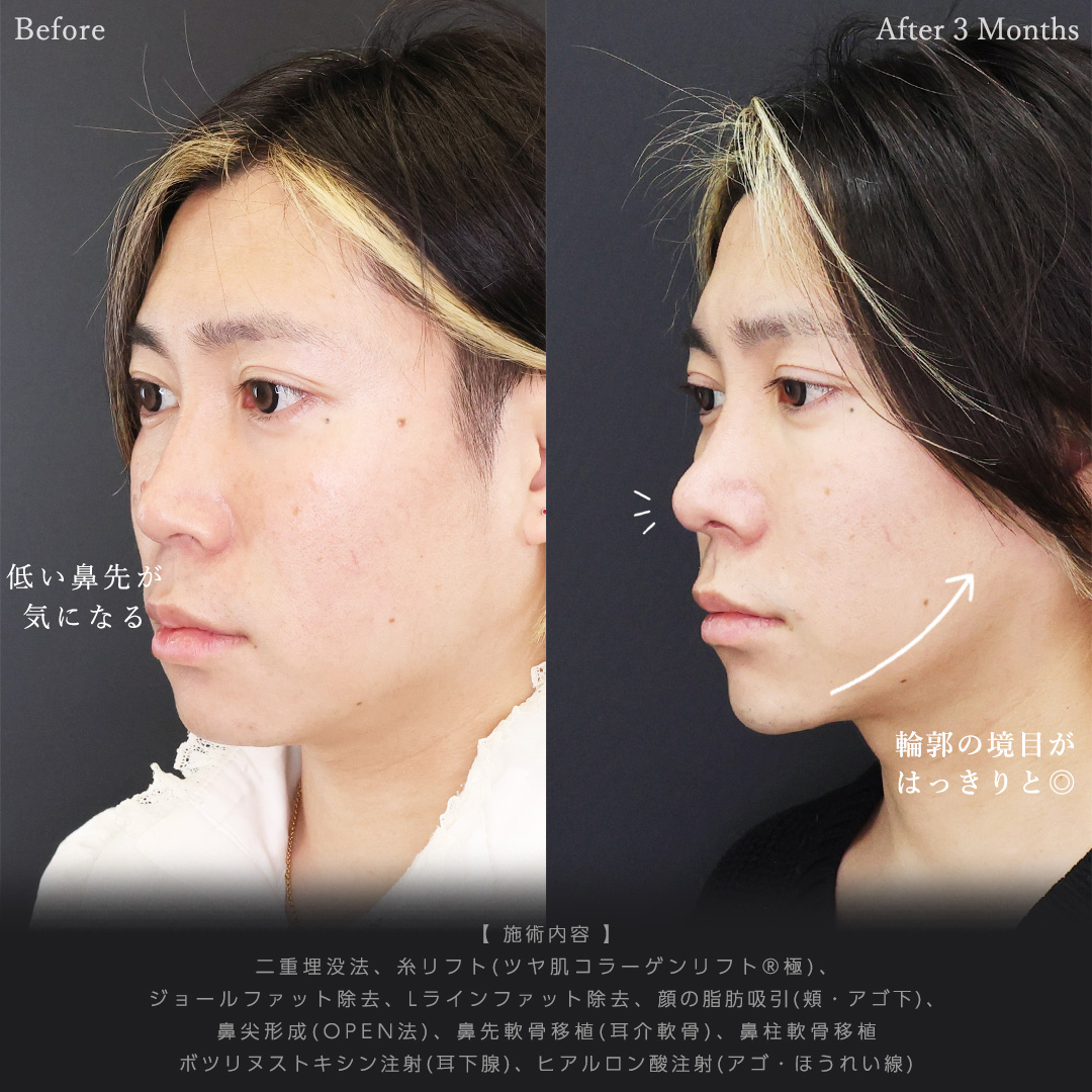 二重埋没法/TAC式 ツヤ肌コラーゲンリフト®/ジョールファット除去の症例写真 施術前後 