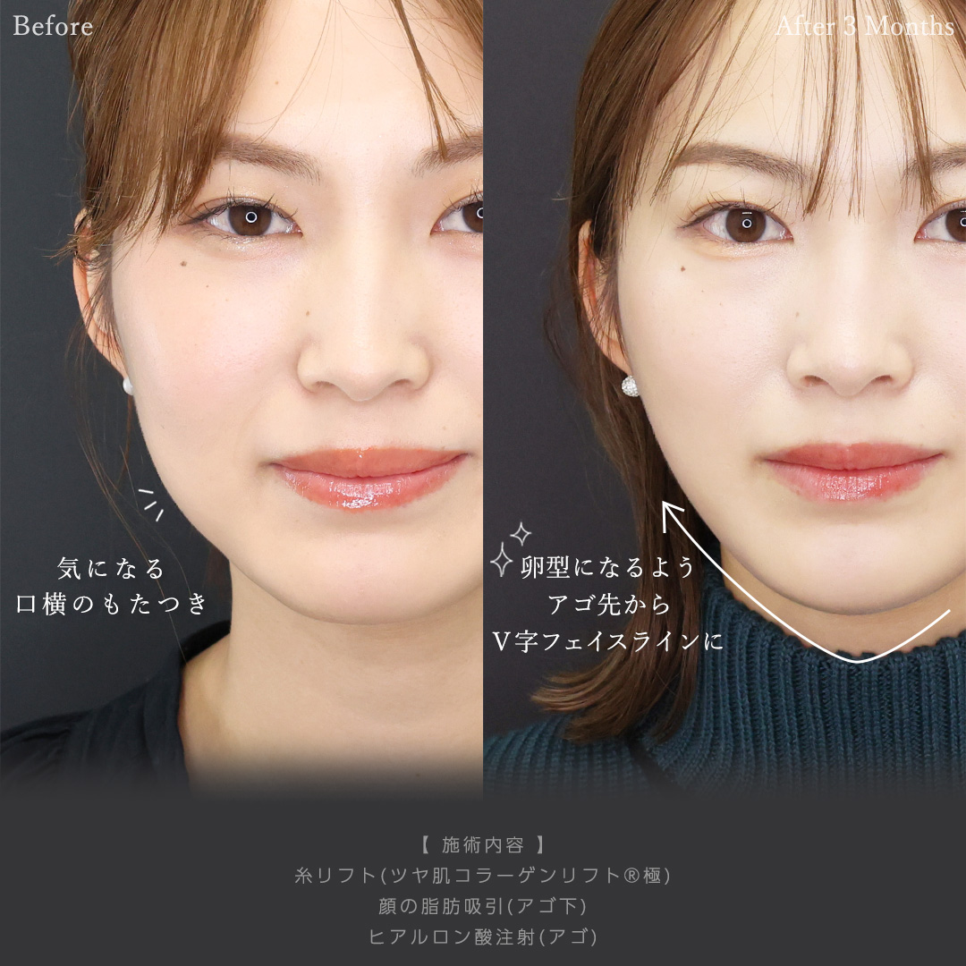 TAC式 ツヤ肌コラーゲンリフト®/顔の脂肪吸引/顎のヒアルロン酸注射の症例写真 施術前後
