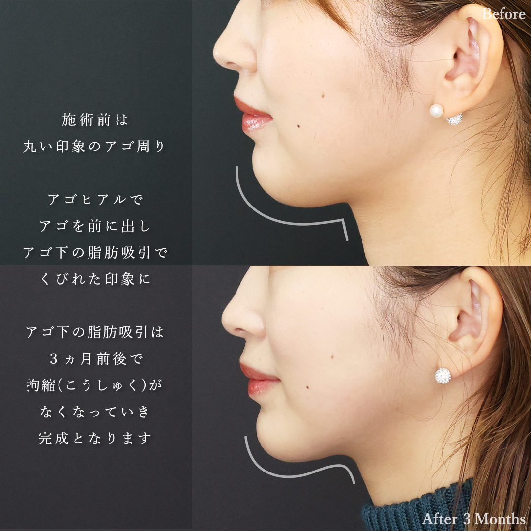 TAC式 ツヤ肌コラーゲンリフト®/顔の脂肪吸引/顎のヒアルロン酸注射の症例写真 施術前後