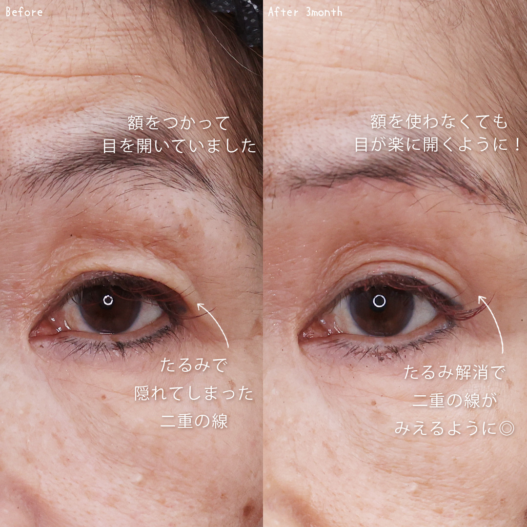 眉毛下切開術の症例写真 施術前後
