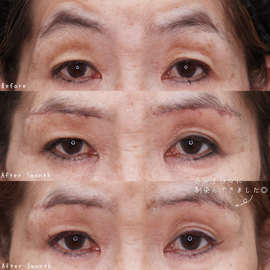 眉毛下切開術の症例写真 施術前後