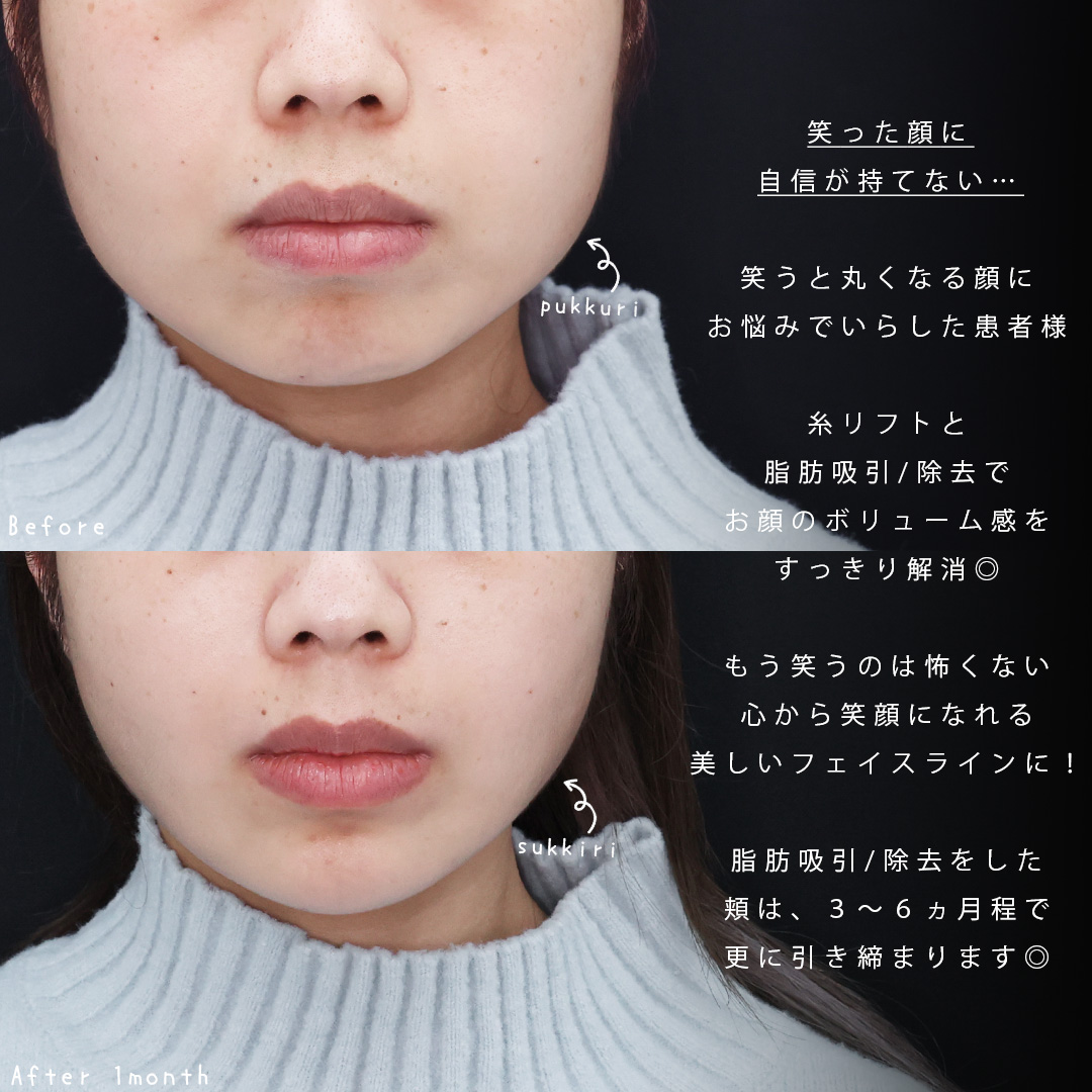 小顔整形｜パーフェクトフェイスライン/TAC式 ツヤ肌コラーゲンリフト®/バッカルファット除去の症例写真 施術前後 
