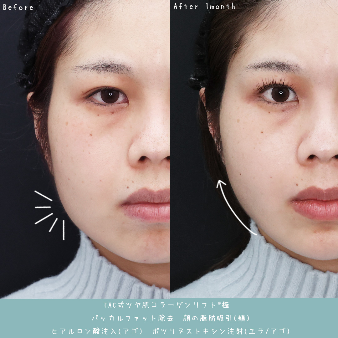 小顔整形｜パーフェクトフェイスライン/TAC式 ツヤ肌コラーゲンリフト®/バッカルファット除去の症例写真 施術前後 