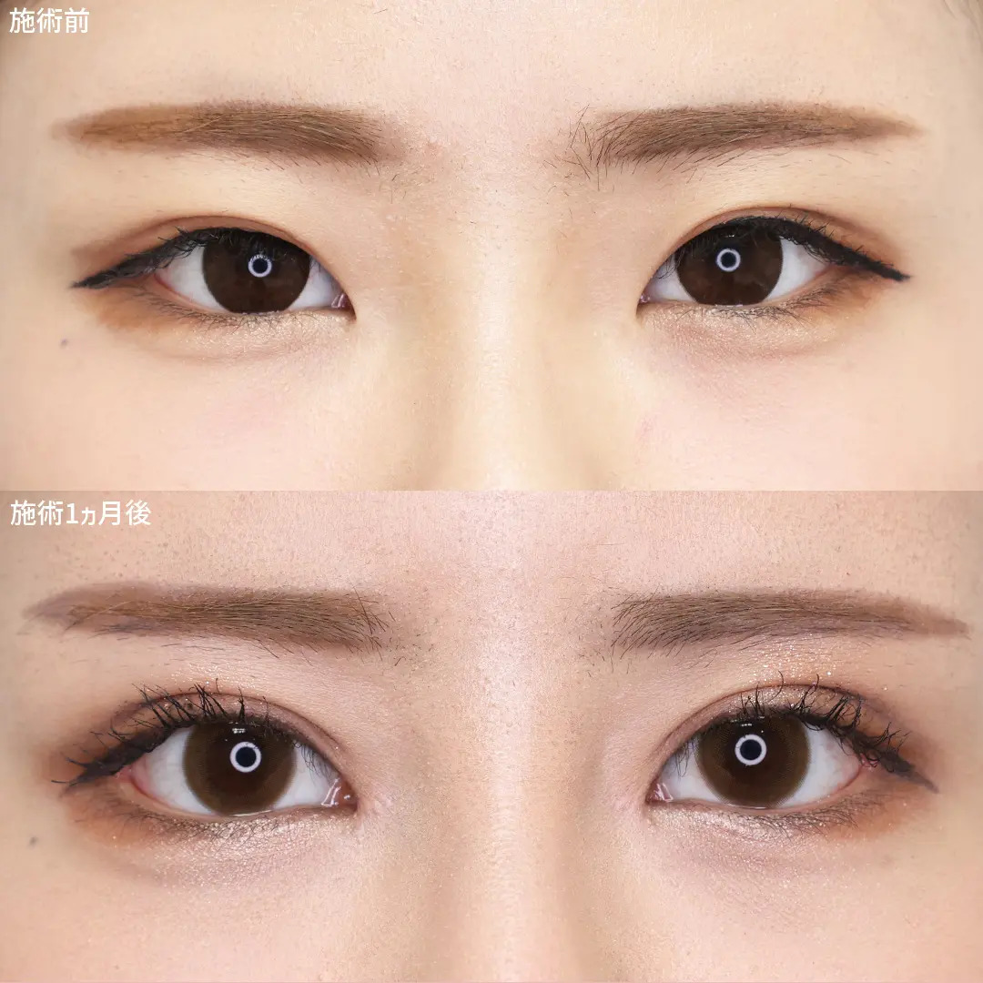 【マリエ先生】の別人級目元切開術