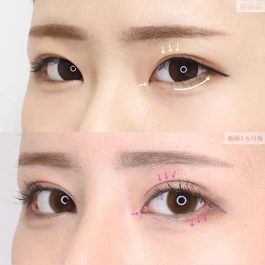 二重切開（全切開法）/目尻切開術/目頭切開術の症例写真 施術前後 