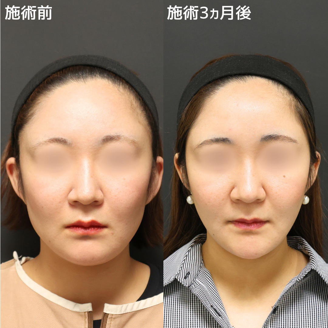 《Dr.まりえの小顔術》口元のたるみがすっきり改善