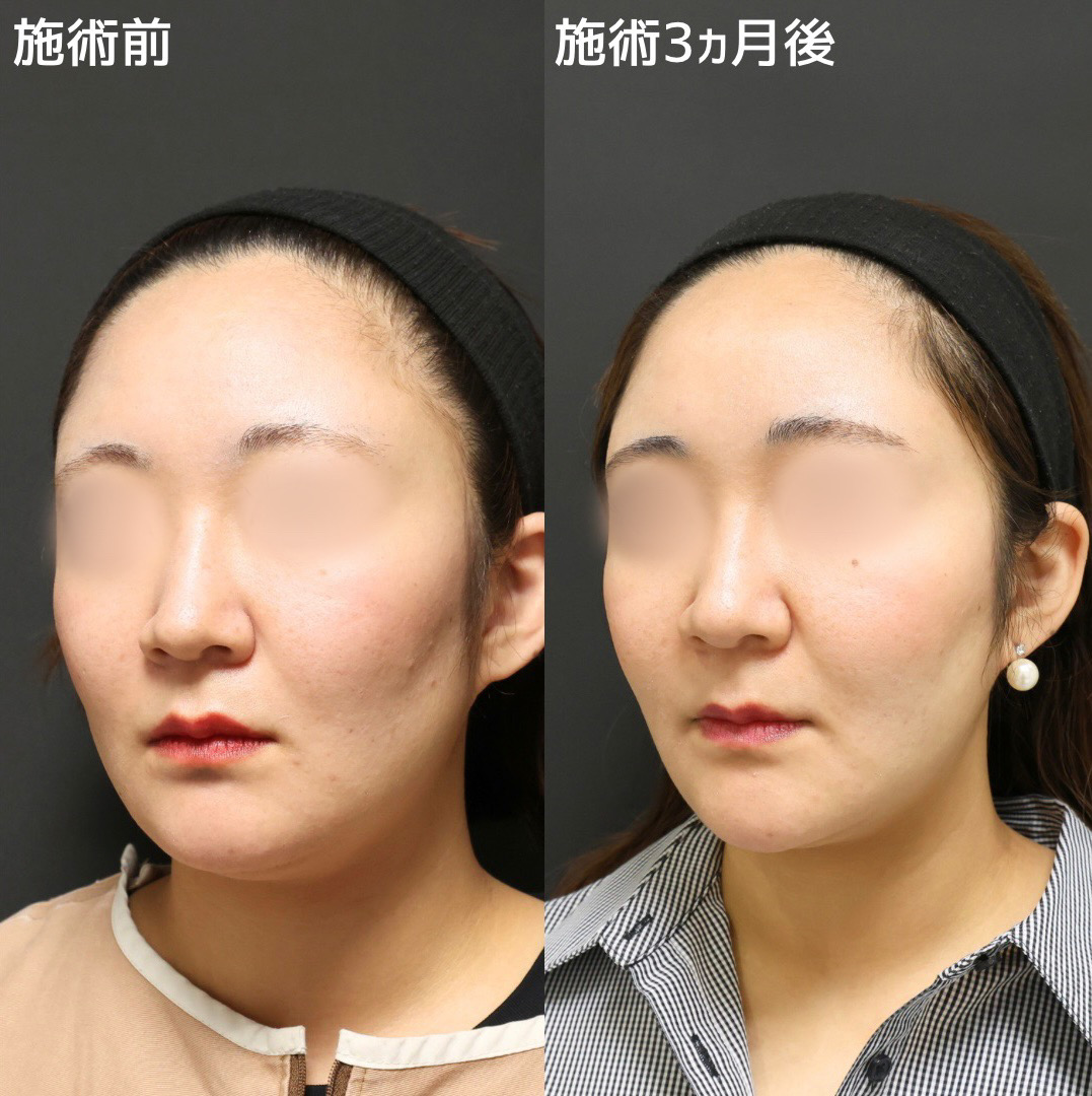 TAC式 ツヤ肌コラーゲンリフト®/Lラインファット除去（エラ下脂肪除去）/ジョールファット除去の症例写真 施術前後 