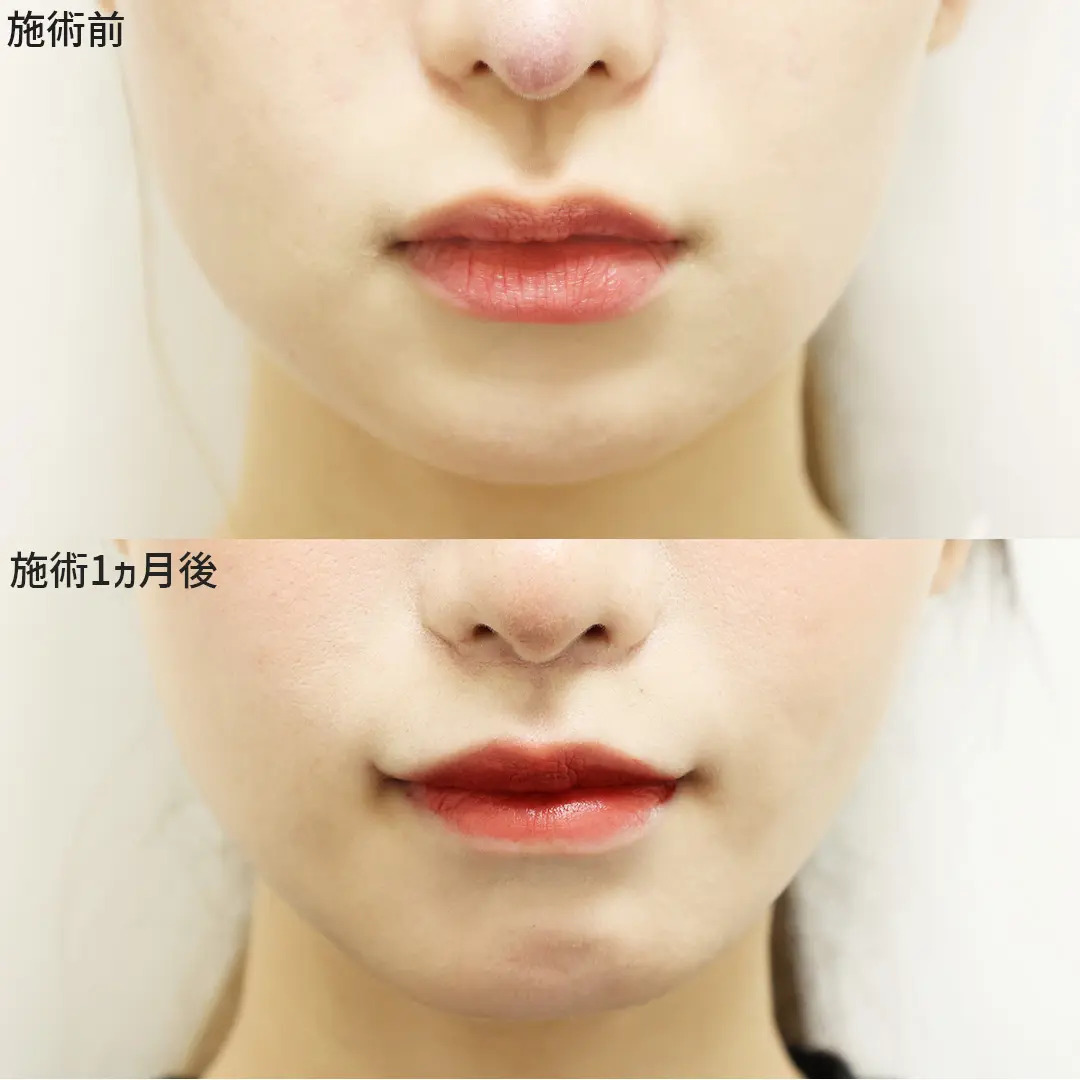 【口角リフト×人中短縮】で叶える口元美人