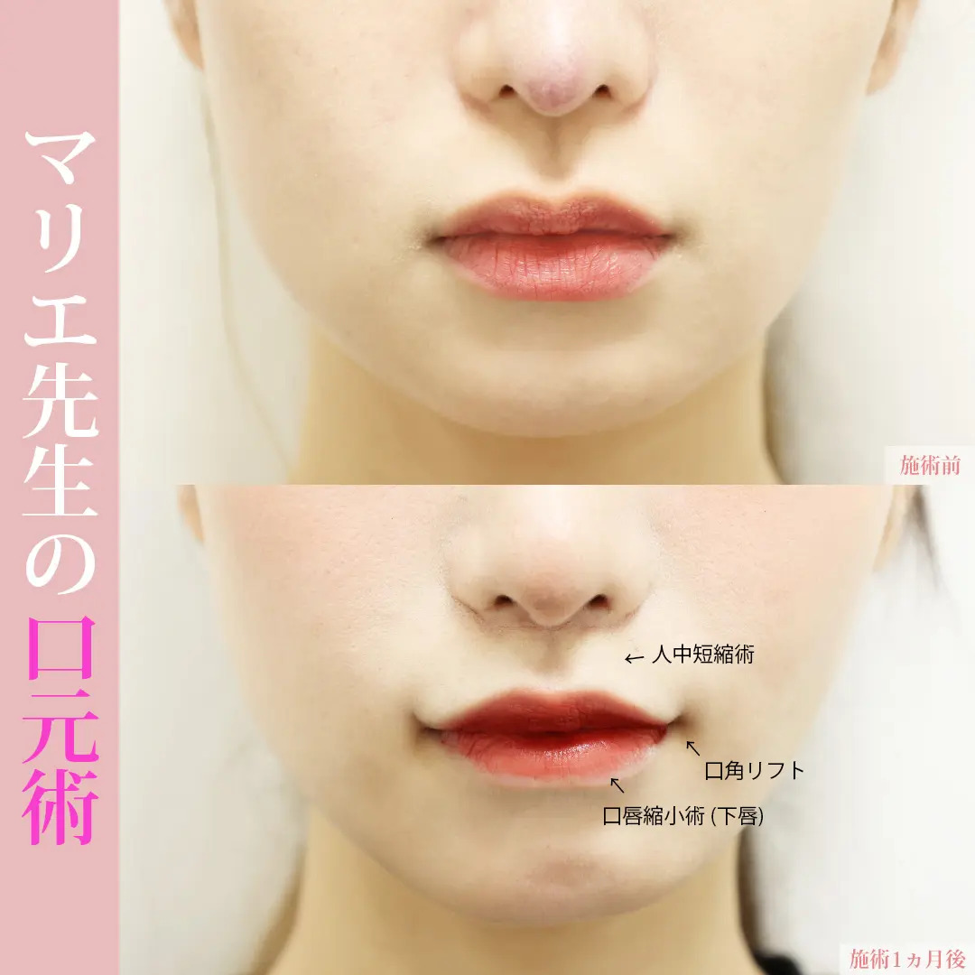 口唇縮小術/口角挙上・リフト（マイクロ切開法・内側法/口内法）/人中短縮術(リップリフト)・外側人中短縮術の症例写真 施術前後 