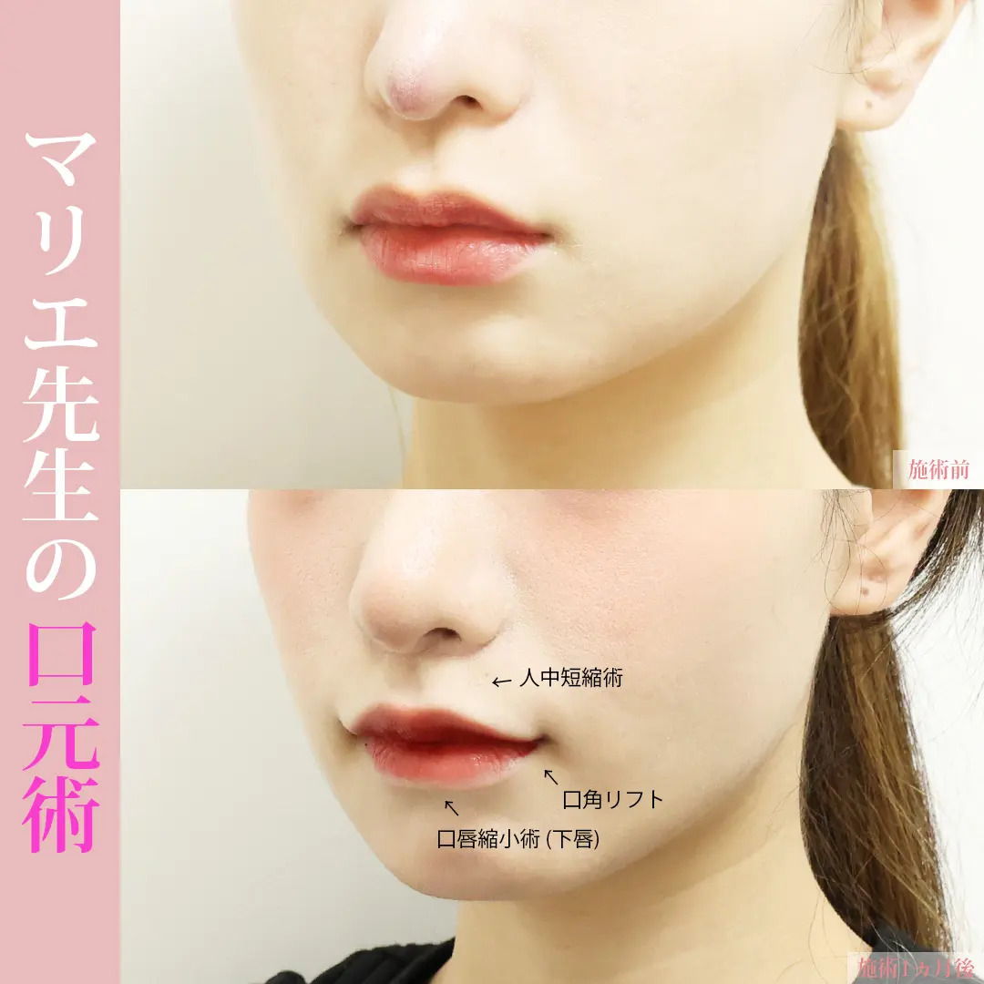 口唇縮小術/口角挙上・リフト（マイクロ切開法・内側法/口内法）/人中短縮術(リップリフト)・外側人中短縮術の症例写真 施術前後 