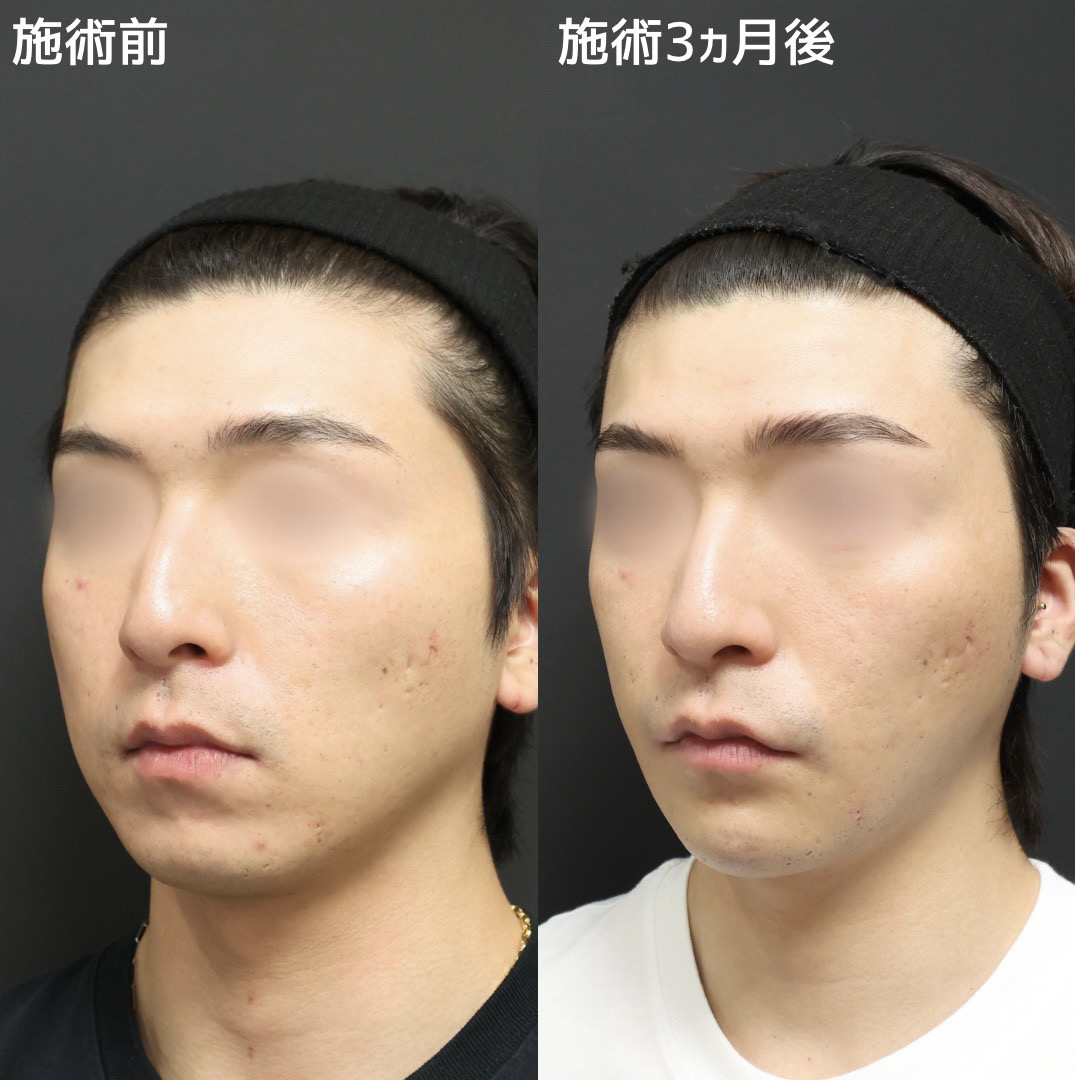 TAC式 ツヤ肌コラーゲンリフト®/ジョールファット除去/Lラインファット除去（エラ下脂肪除去）の症例写真 施術前後 