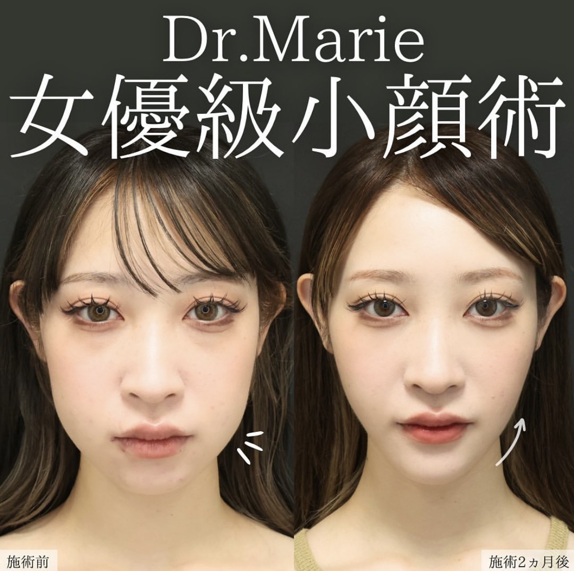 TAC式 ツヤ肌コラーゲンリフト®/ジョールファット除去/Lラインファット除去（エラ下脂肪除去）の症例写真 施術前後 