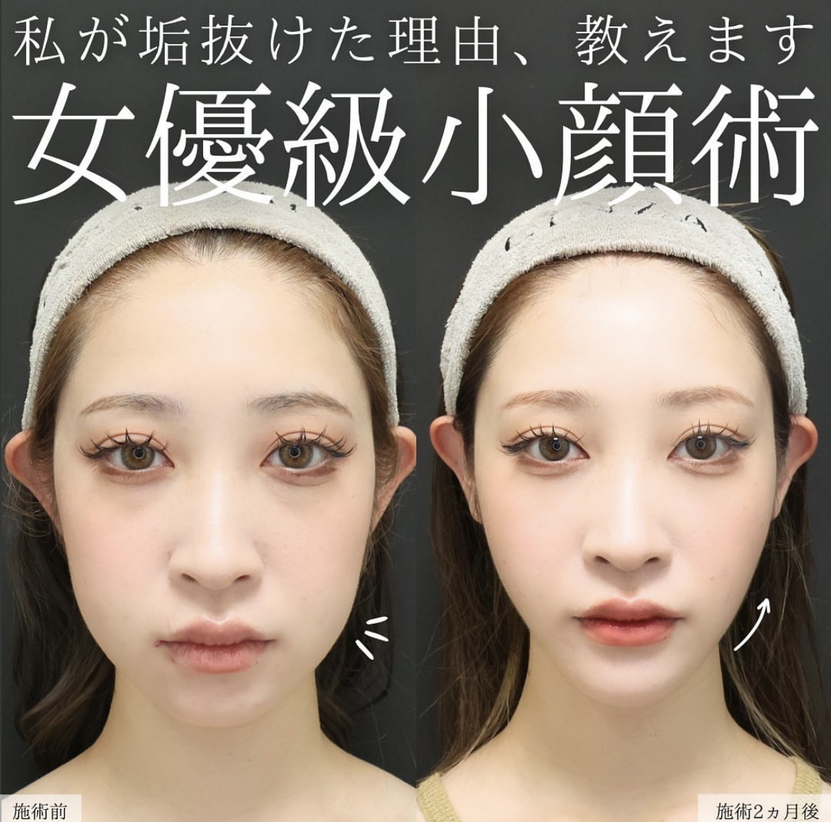 TAC式 ツヤ肌コラーゲンリフト®/ジョールファット除去/Lラインファット除去（エラ下脂肪除去）の症例写真 施術前後 