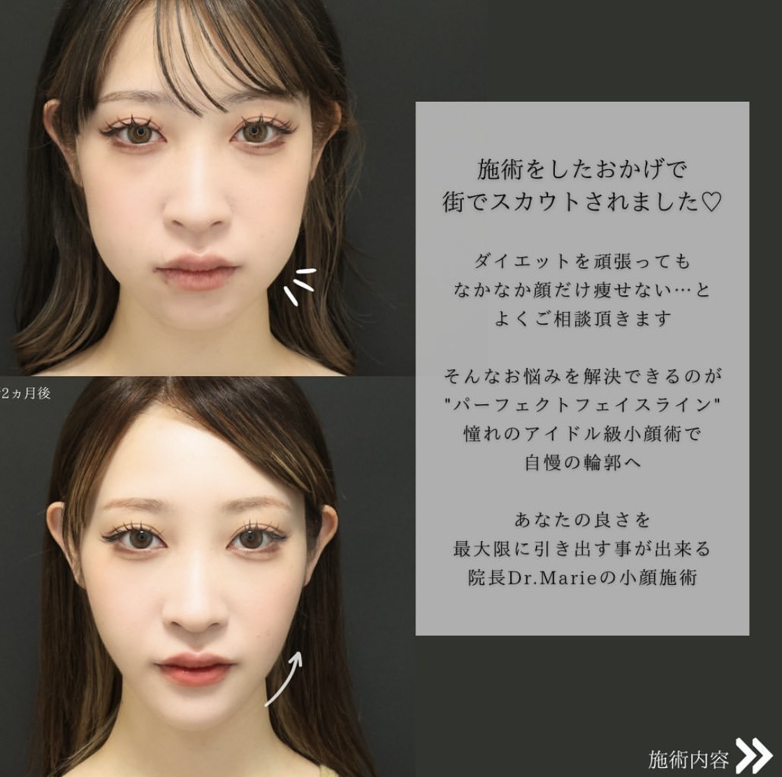 TAC式 ツヤ肌コラーゲンリフト®/ジョールファット除去/Lラインファット除去（エラ下脂肪除去）の症例写真 施術前後 