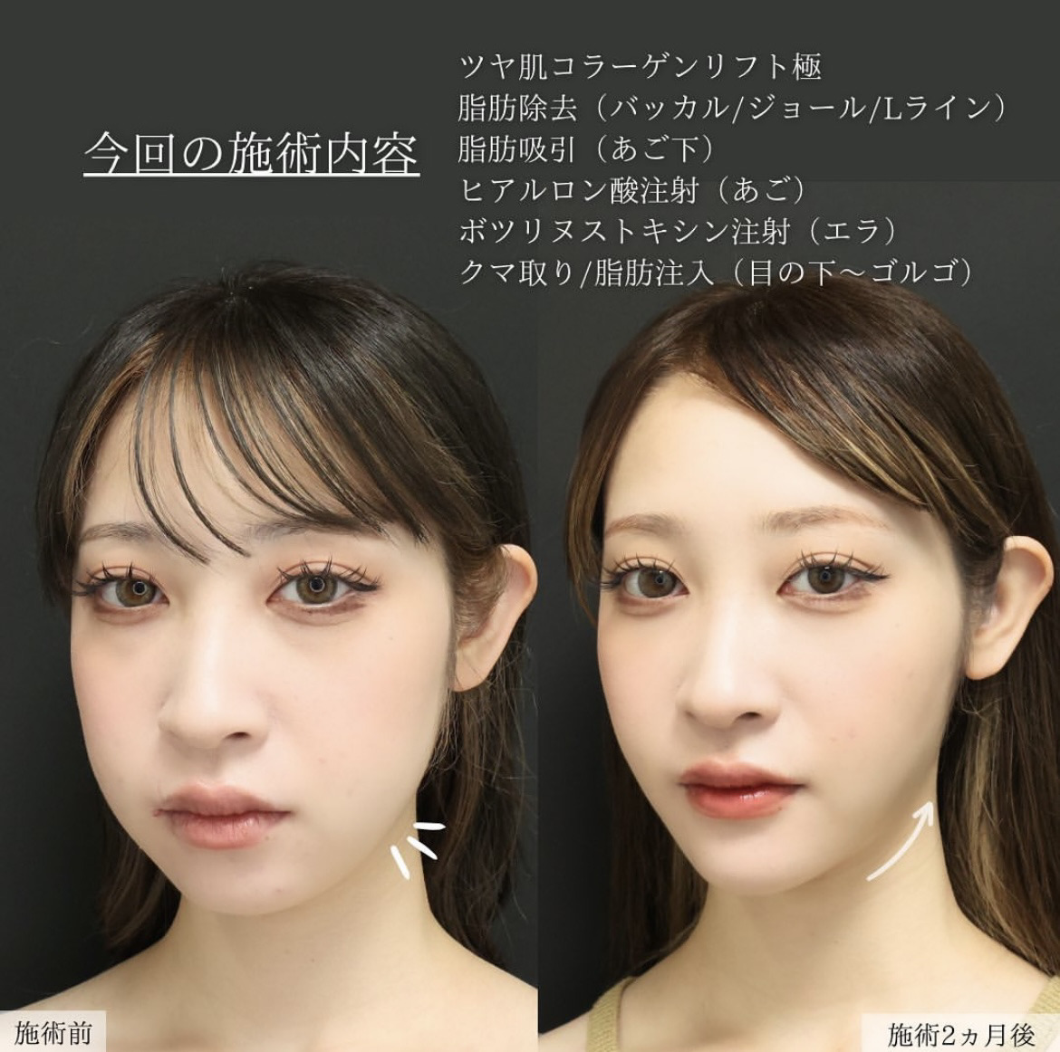 TAC式 ツヤ肌コラーゲンリフト®/ジョールファット除去/Lラインファット除去（エラ下脂肪除去）の症例写真 施術前後 