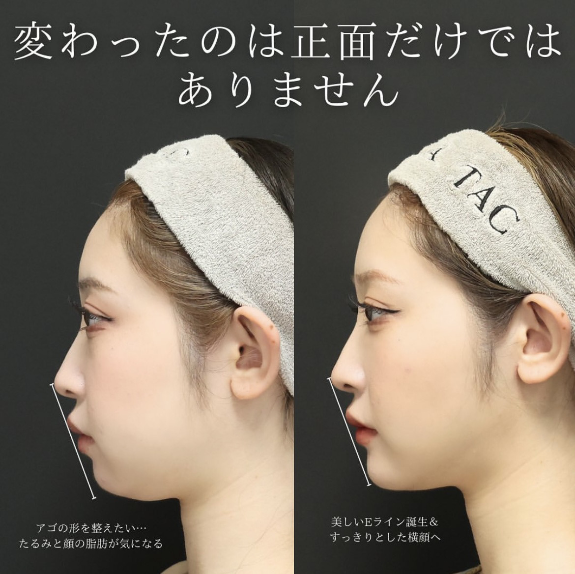 TAC式 ツヤ肌コラーゲンリフト®/ジョールファット除去/Lラインファット除去（エラ下脂肪除去）の症例写真 施術前後 