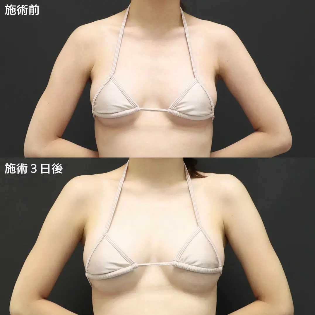 ヒアルロン酸注入豊胸術（グラビアバスト）の症例写真 施術前後 