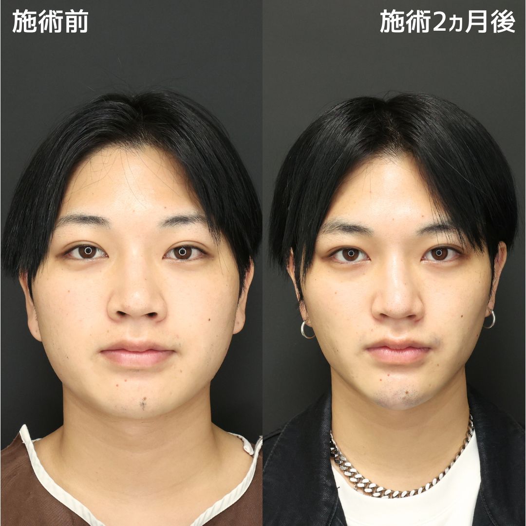 《男性美容》輪郭施術で垢抜けイケメン誕生