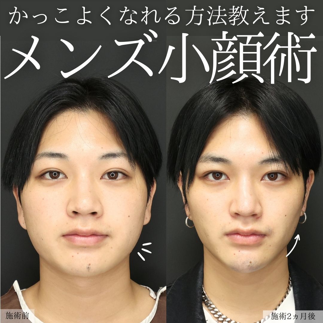 TAC式 ツヤ肌コラーゲンリフト®/バッカルファット除去/ジョールファット除去の症例写真 施術前後 