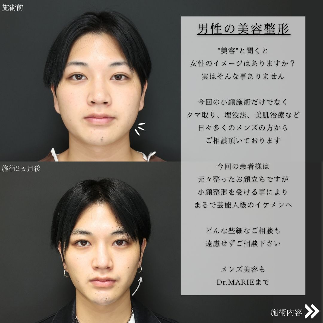 TAC式 ツヤ肌コラーゲンリフト®/バッカルファット除去/ジョールファット除去の症例写真 施術前後 