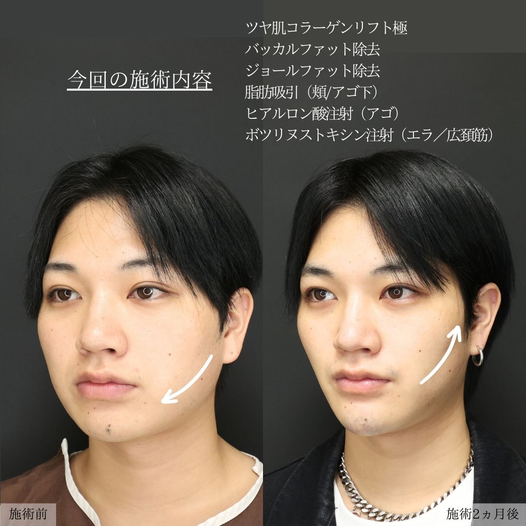 TAC式 ツヤ肌コラーゲンリフト®/バッカルファット除去/ジョールファット除去の症例写真 施術前後 