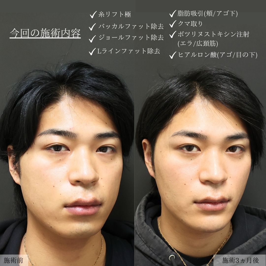 TAC式 ツヤ肌コラーゲンリフト®/バッカルファット除去/ジョールファット除去の症例写真 施術前後 