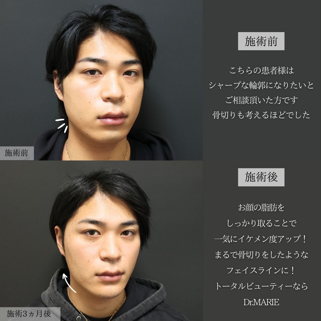 TAC式 ツヤ肌コラーゲンリフト®/バッカルファット除去/ジョールファット除去の症例写真 施術前後 