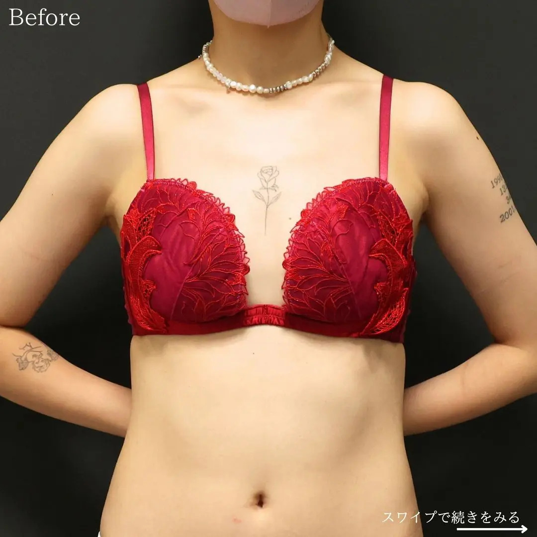 シリコンバッグ豊胸（人工乳腺バッグ）の症例写真 施術前後 