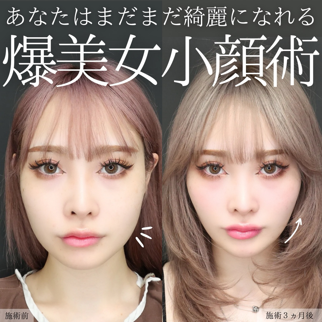 TAC式 ツヤ肌コラーゲンリフト®/バッカルファット除去/ジョールファット除去の症例写真 施術前後 