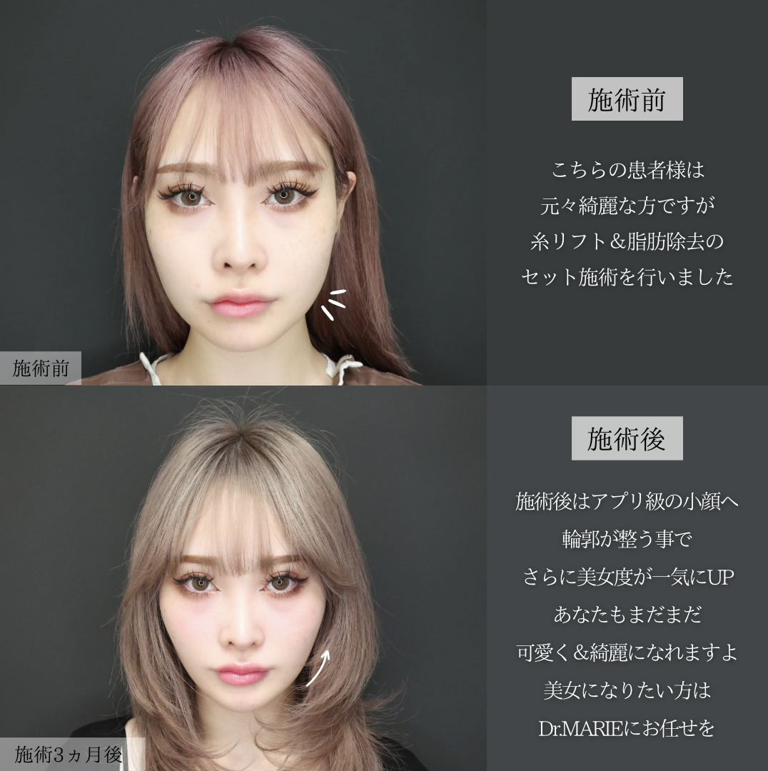 TAC式 ツヤ肌コラーゲンリフト®/バッカルファット除去/ジョールファット除去の症例写真 施術前後 