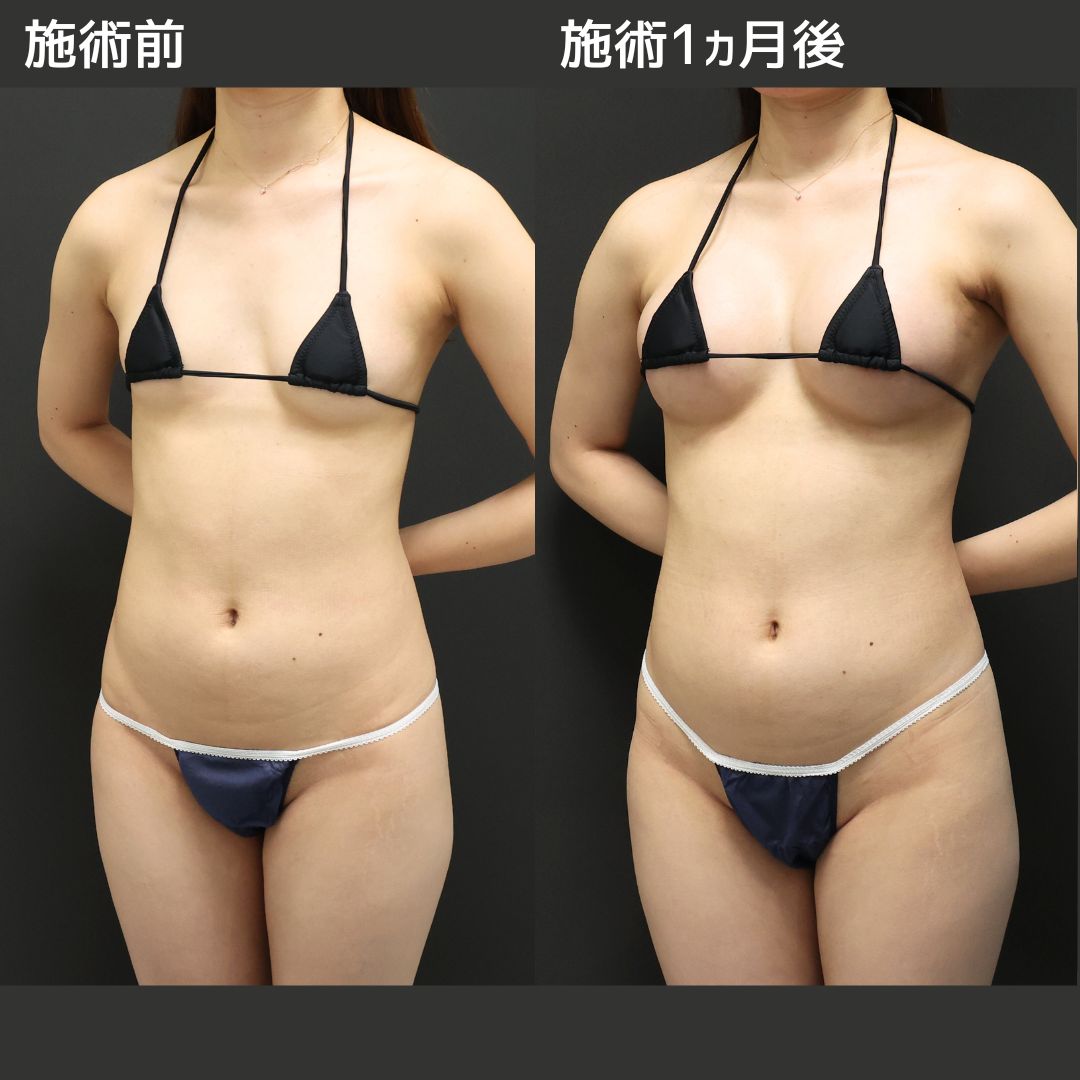《シリコンバッグ》Dr.まりえのバレない豊胸術
