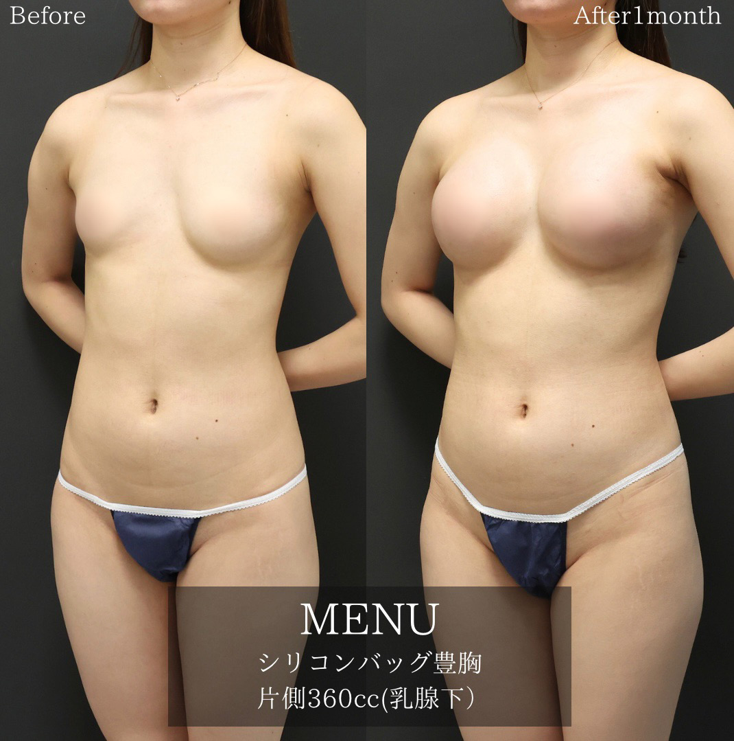 シリコンバッグ豊胸（人工乳腺バッグ）の症例写真 施術前後 