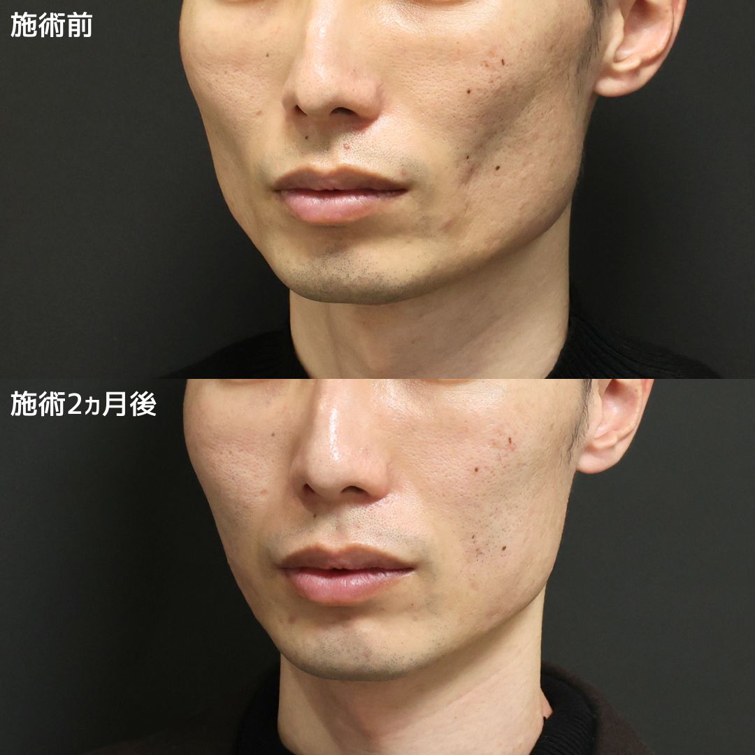 《エラ張り×頬のコケ》プチ整形で長年のコンプレックスを改善