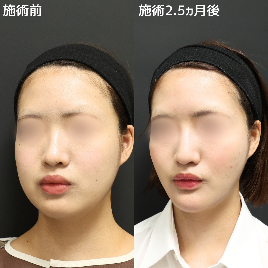 TAC式 ツヤ肌コラーゲンリフト®/ジョールファット除去/バッカルファット除去の症例写真 施術前後 