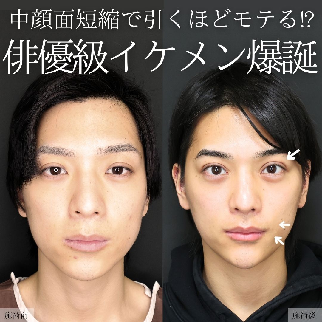 TAC式 ツヤ肌コラーゲンリフト®/下眼瞼脱脂術（目の下のたるみ取り・目の下の脂肪ふくらみ取り）/目の下のヒアルロン酸注射の症例写真 施術前後 