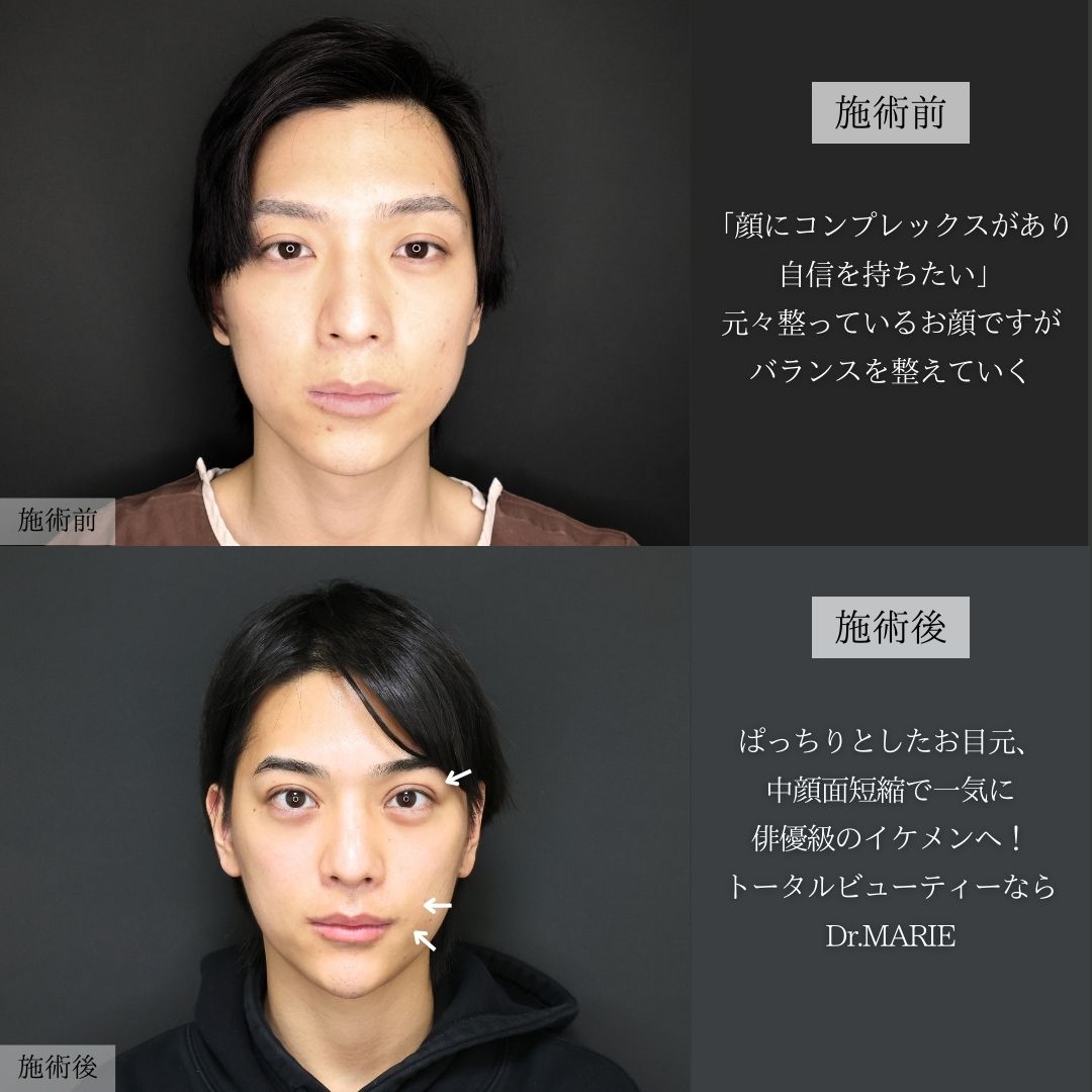 TAC式 ツヤ肌コラーゲンリフト®/下眼瞼脱脂術（目の下のたるみ取り・目の下の脂肪ふくらみ取り）/目の下のヒアルロン酸注射の症例写真 施術前後 