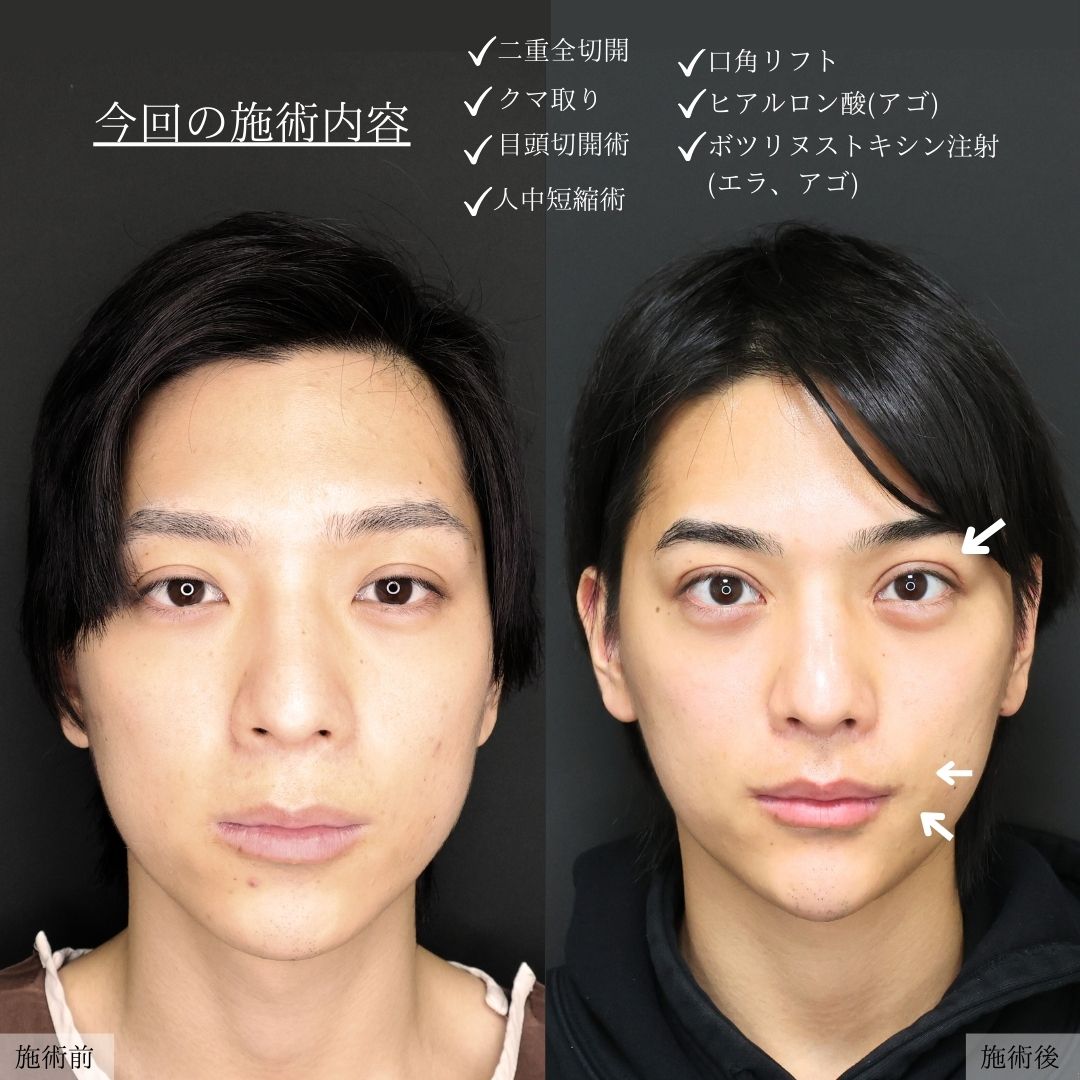 TAC式 ツヤ肌コラーゲンリフト®/下眼瞼脱脂術（目の下のたるみ取り・目の下の脂肪ふくらみ取り）/目の下のヒアルロン酸注射の症例写真 施術前後 