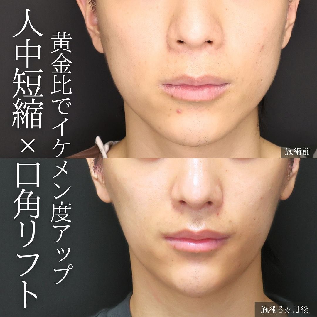 TAC式 ツヤ肌コラーゲンリフト®/下眼瞼脱脂術（目の下のたるみ取り・目の下の脂肪ふくらみ取り）/目の下のヒアルロン酸注射の症例写真 施術前後 