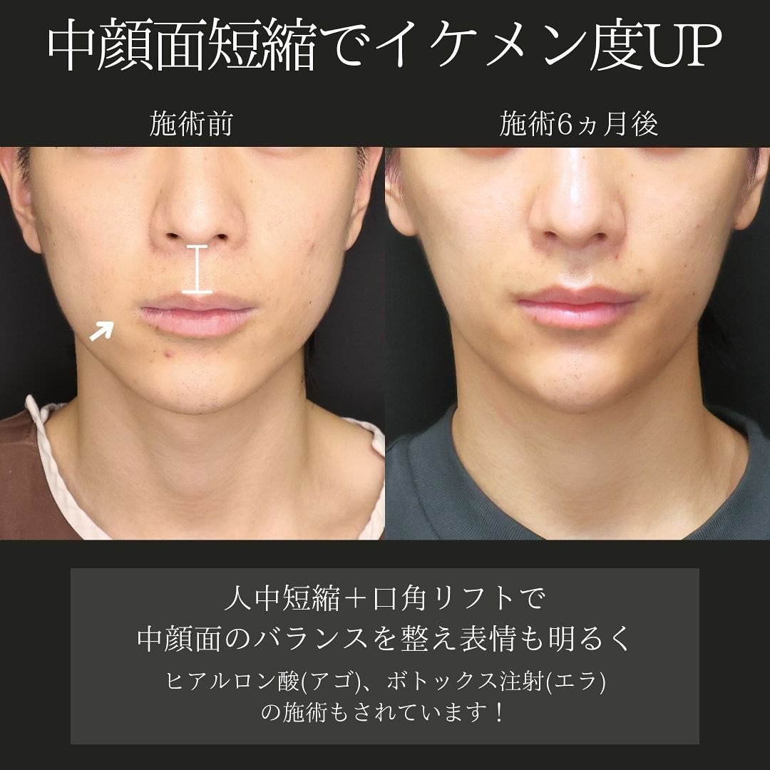 TAC式 ツヤ肌コラーゲンリフト®/下眼瞼脱脂術（目の下のたるみ取り・目の下の脂肪ふくらみ取り）/目の下のヒアルロン酸注射の症例写真 施術前後 