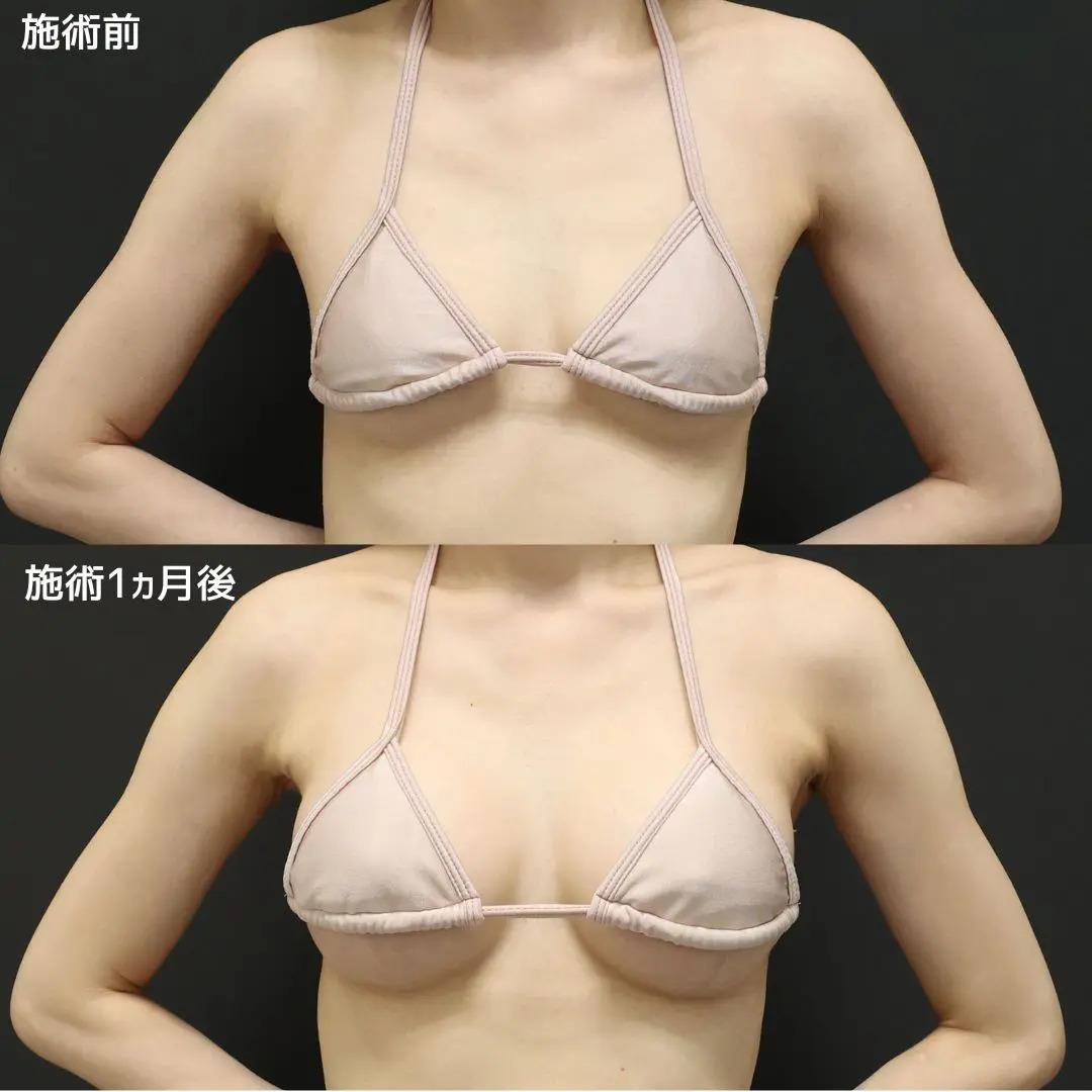 シリコンバッグ豊胸（人工乳腺バッグ）の症例写真 施術前後 