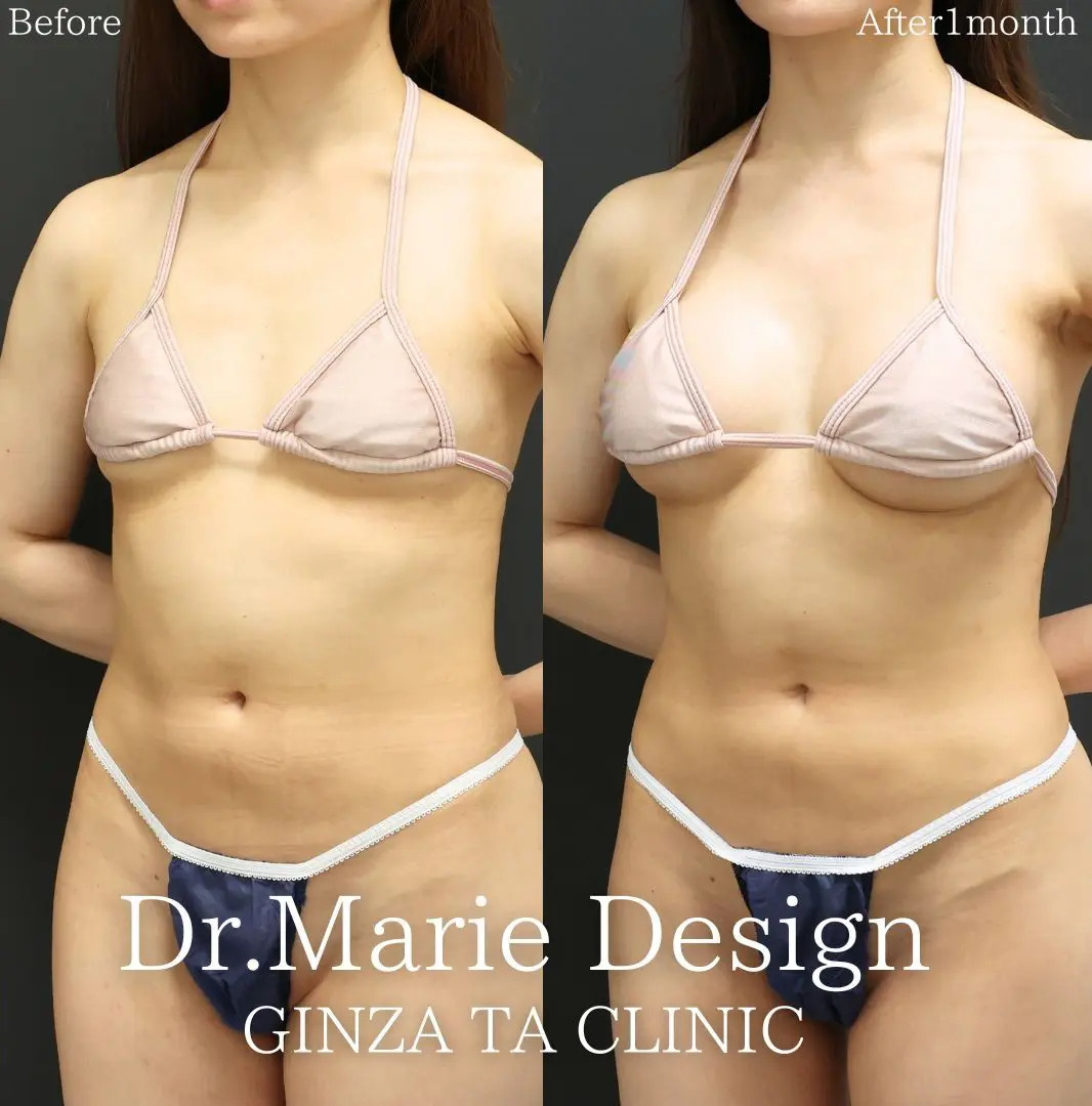 シリコンバッグ豊胸（人工乳腺バッグ）の症例写真 施術前後 