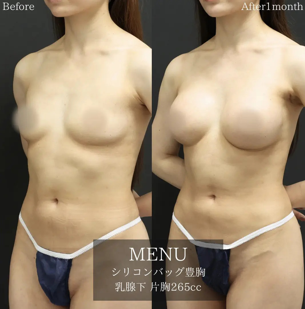 シリコンバッグ豊胸（人工乳腺バッグ）の症例写真 施術前後 