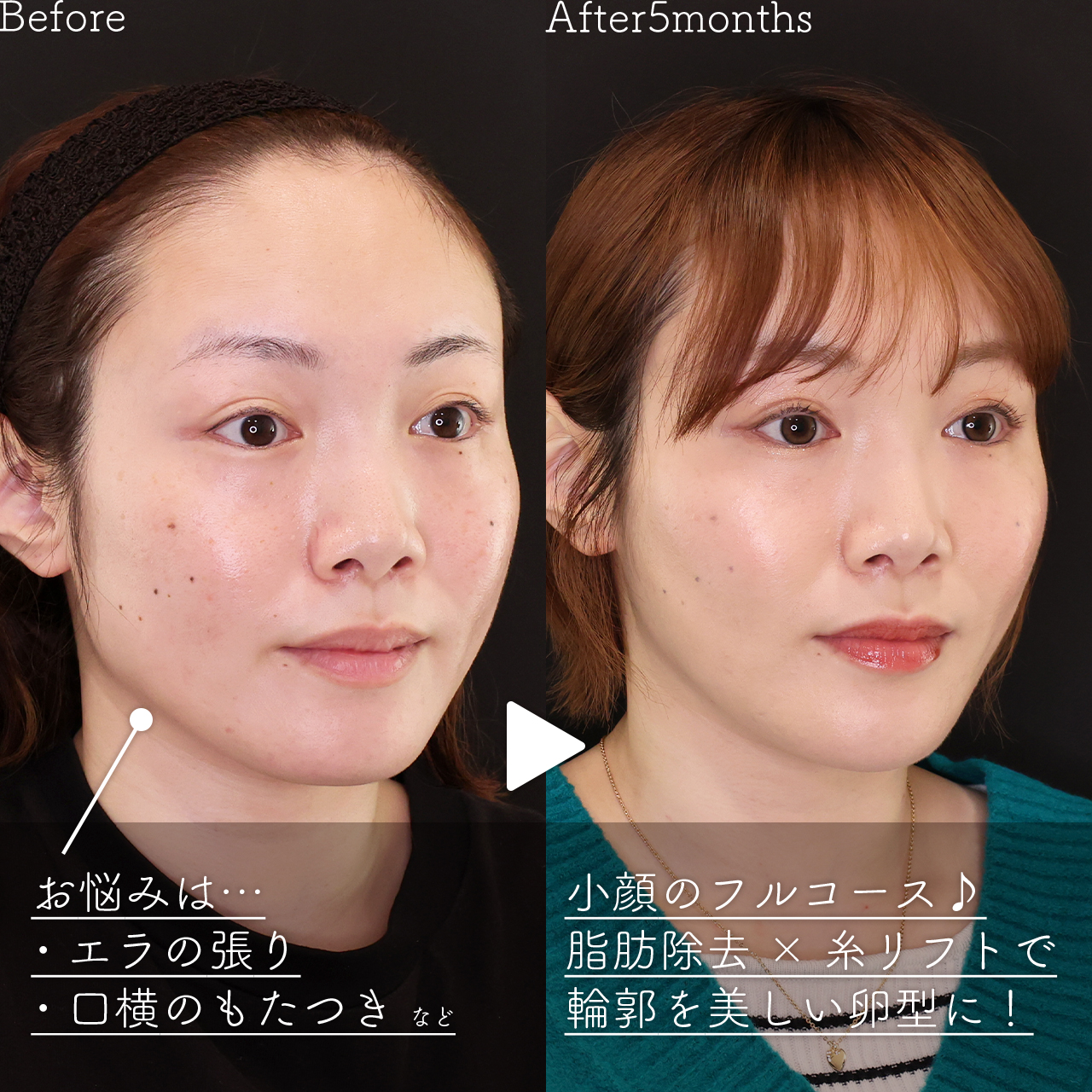 TAC式 ツヤ肌コラーゲンリフト®/ジョールファット除去/エラボトックス注射の症例写真 施術前後 