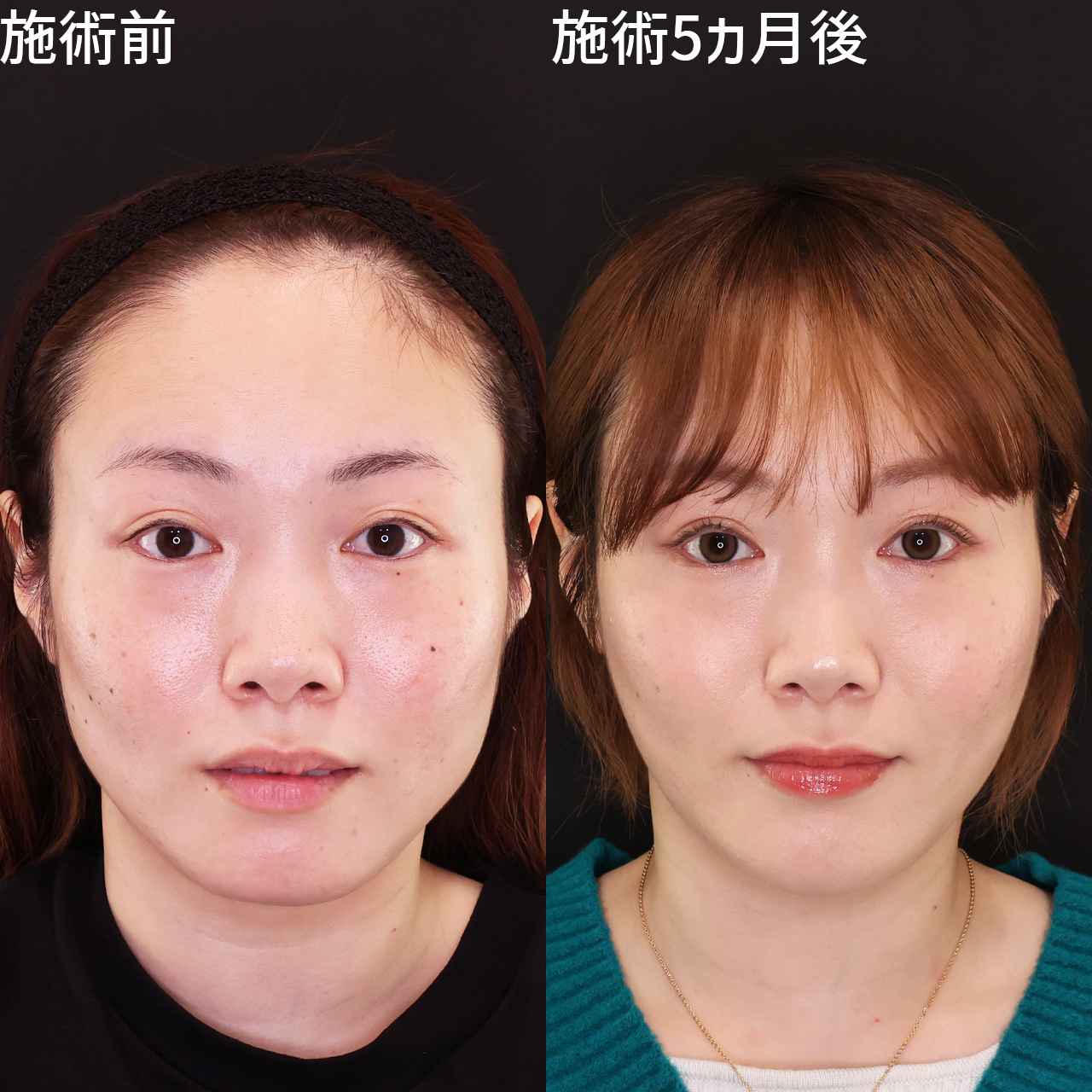 どの角度から見ても美しいDr.もりもりの小顔術【小顔複合術】