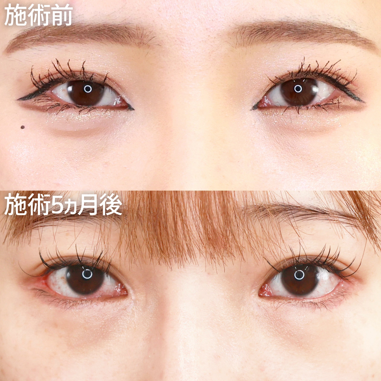 グラマラスライン（タレ目形成）/目尻切開術/目尻靭帯移動術の症例写真 施術前後 