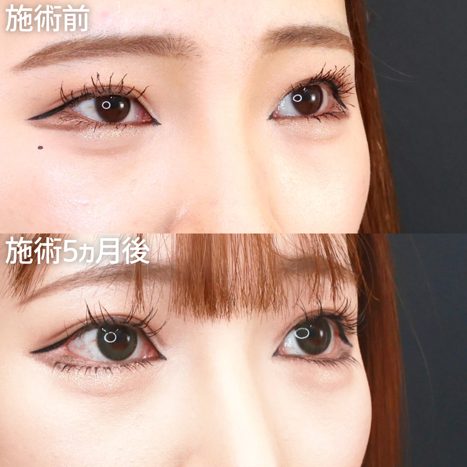 グラマラスライン（タレ目形成）/目尻切開術/目尻靭帯移動術の症例写真 施術前後 